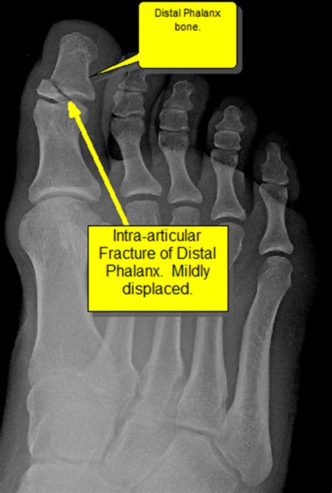Left great toe pain icd 10 - ICD-10-CM Diagnosis Code S93.122S. ... of the extremities with rest pain, left leg. ... Displaced unspecified fracture of left great toe, initial encounter for closed ...